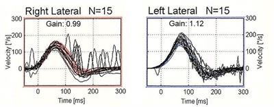 Presence of corrective saccades in patients with normal vestibulo-ocular reflex gain in video head impulse test